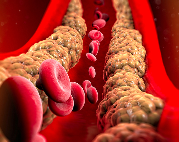 Холестерин не-ЛПВП и резидуальный риск сердечно-сосудистых событий