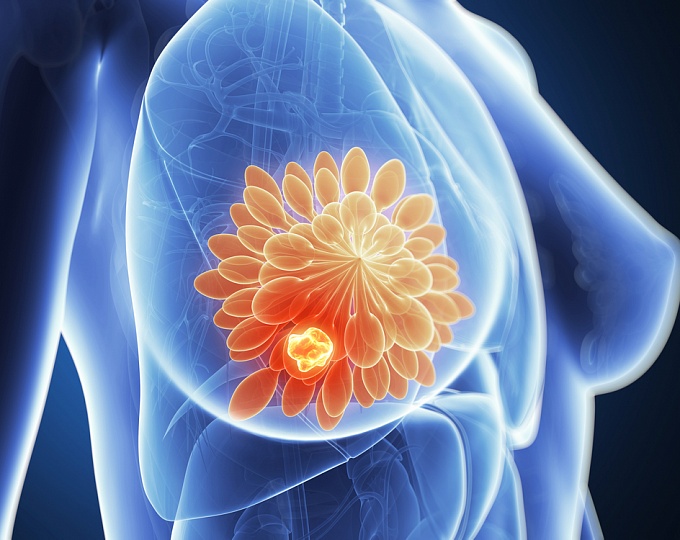 Помогает ли скрининг рака молочной железы в снижении частоты прогрессирующих стадий рака? 