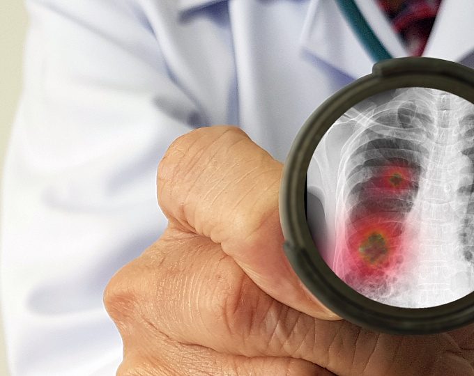 Роль ультразвукового исследования легких в диагностике внебольничной пневмонии в условиях ОРИТ