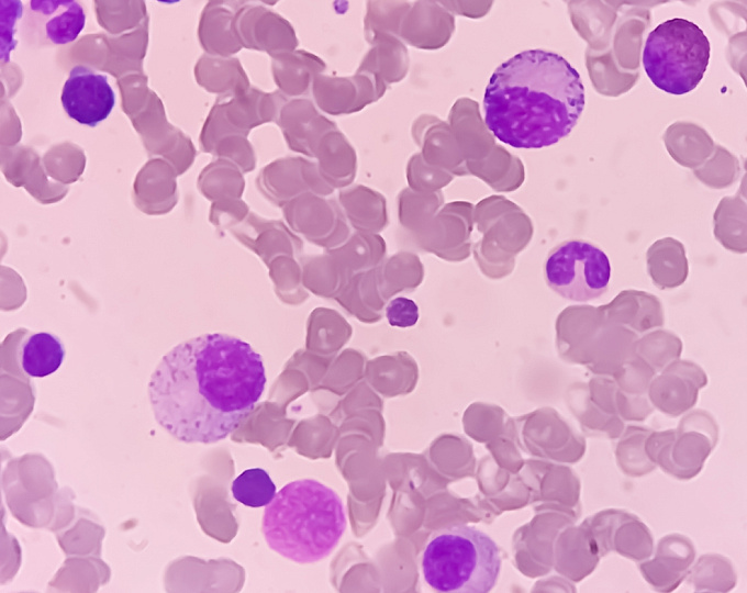 Локальная CAR-T терапия неходжкинских лимфом