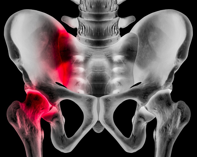 Бисфосфонаты и риск перипротетических переломов бедренной кости