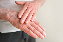 Внутривенный иммуноглобулин в лечении кожных симптомов у пациентов с дерматомиозитом