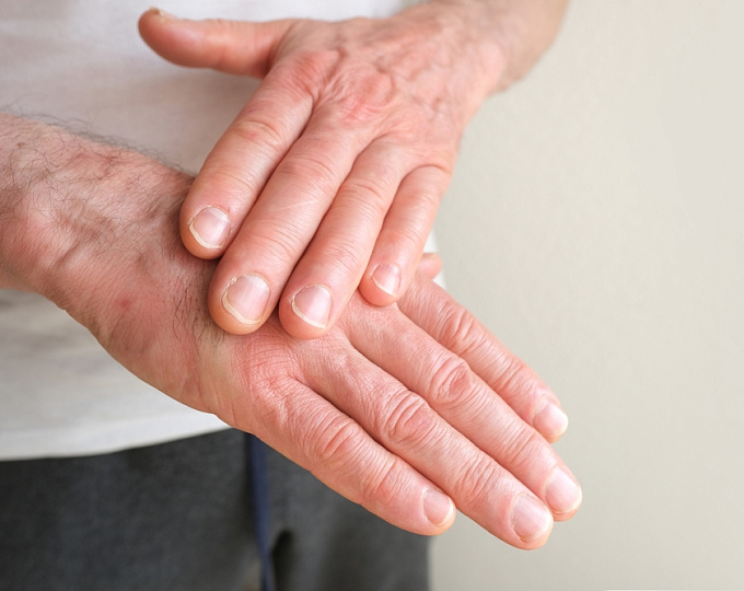 Внутривенный иммуноглобулин в лечении кожных симптомов у пациентов с дерматомиозитом
