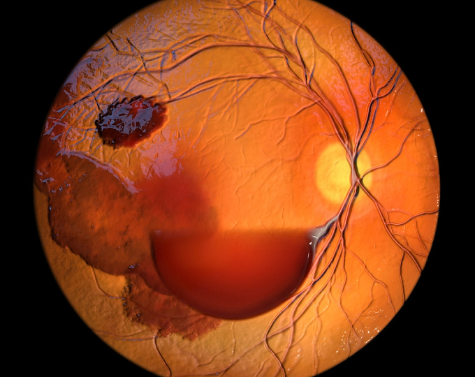 Риск внутриглазного кровоизлияния у пациентов с возрастной макулярной дегенерацией на фоне антитромботической терапии