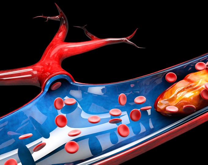 Цитостатик иринотекан повышает риск развития тромбоэмболических событий 