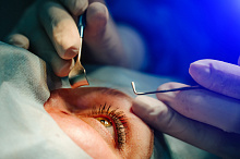 От подозрения на первичную закрытоугольную глаукому до манифестации заболевания: факторы риска