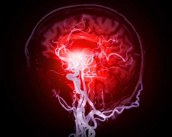 Субарахноидальные кровоизлияния при терапии статинами
