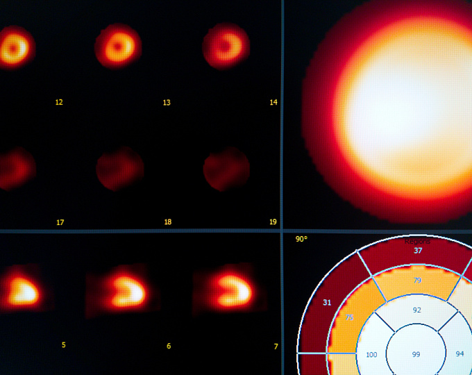 Эффективен ли аспирин при кардиомиопатии Такоцубо?