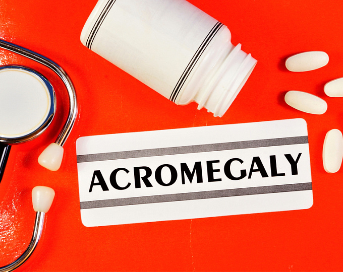 Сахарный диабет у пациентов с акромегалией: распространенность и исходы