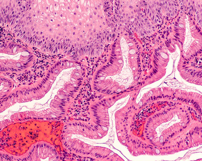 Частота диплазии у пациентов с ультракоротким пищеводом Баррета