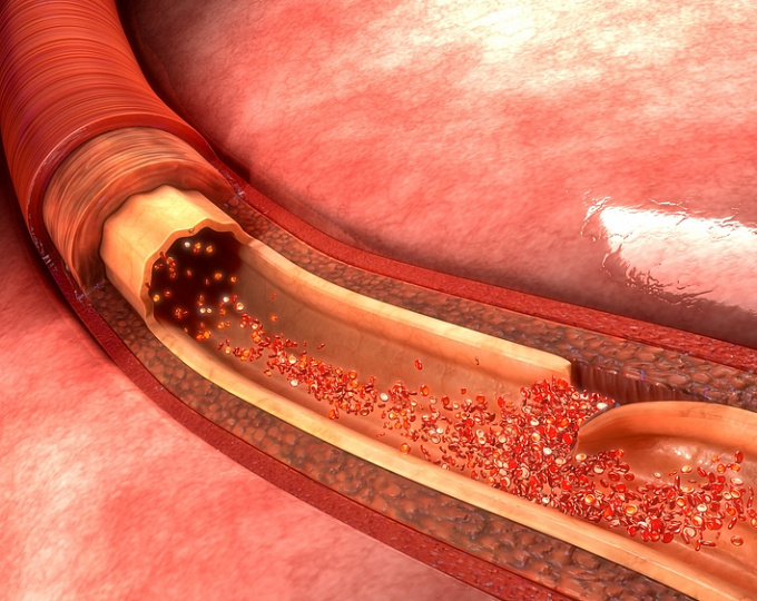 Сравнение препарата АСК с антагонистом витамина К при диссекции цервикальной артерии