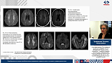 Академический час. Приобретенные токсико-метаболические поражения головного мозга: что может лучевая диагностика