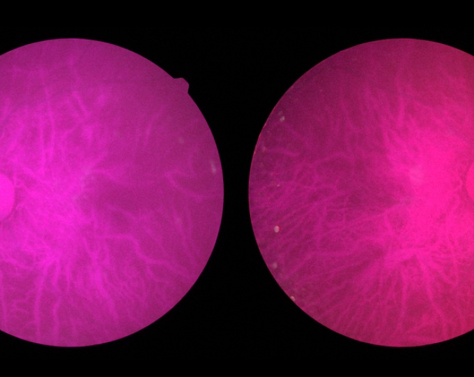 Тяжесть гестационного диабета и риск диабетической ретинопатии у женщин