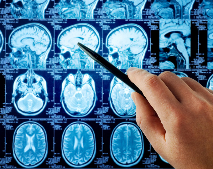 Риск развития эпилепсии после первого эпизода посттравматических судорог у пациентов с травмой головного мозга