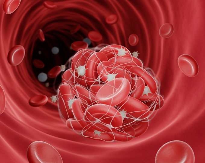 Риск повторного инсульта и транзиторной ишемической атаки у пациентов с сердечным тромбом
