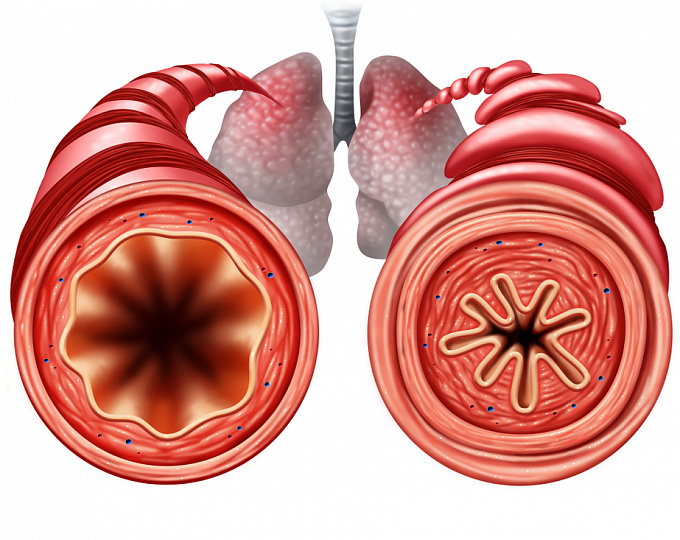 Результаты исследования препарата маситиниб у пациентов с тяжелой бронхиальной астмой