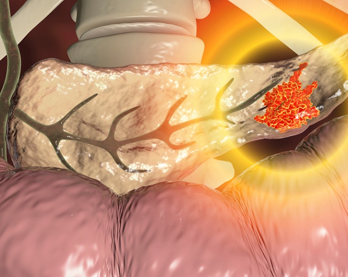 Эффективность иммунотерапии в лечении рака поджелудочной железы под вопросом