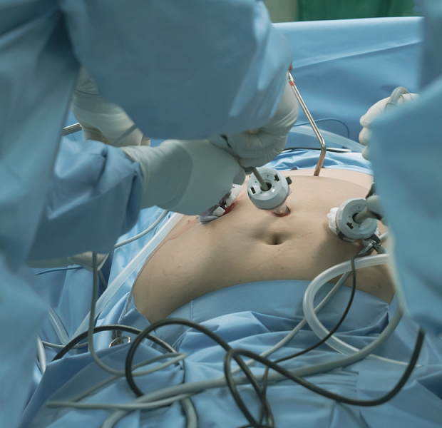 Роль метаболической бариатрической хирургии в улучшении метаболического контроля у пациентов с сахарным диабетом 1 типа