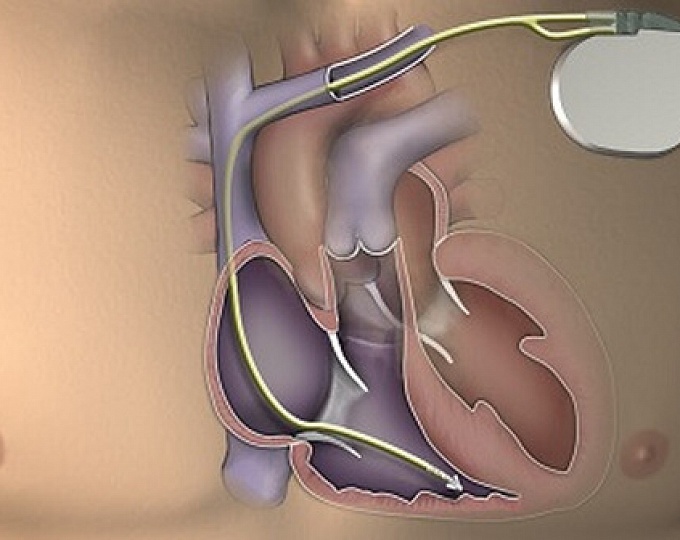 Имплантация кардиовертера-дефибриллятора пациентам с систолической сердечной недостаточностью неишемического генеза