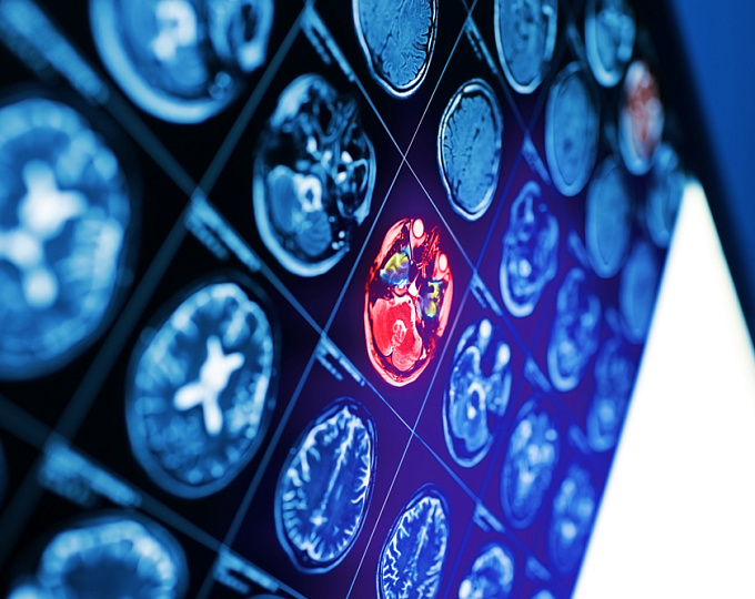 Сравнение риска интракраниальных кровотечений на фоне антикоагулянтов и антиагрегантов