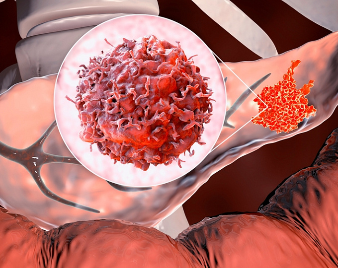 Алкоголь – доказанный фактор рака поджелудочной железы