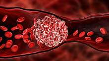 Распространенность и факторы риска артериальной тромбоэмболии у онкологических пациентов