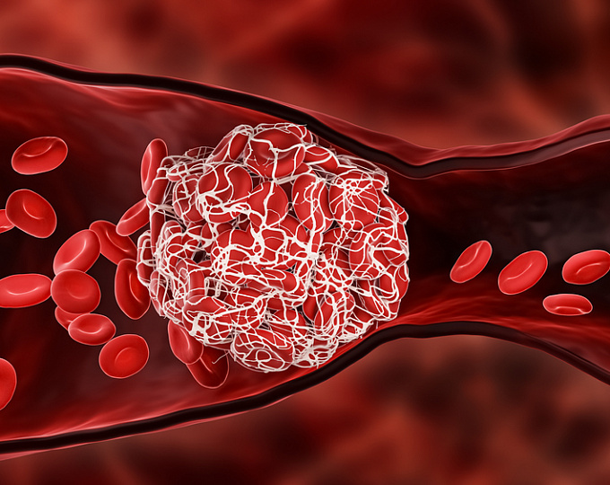 Распространенность и факторы риска артериальной тромбоэмболии у онкологических пациентов