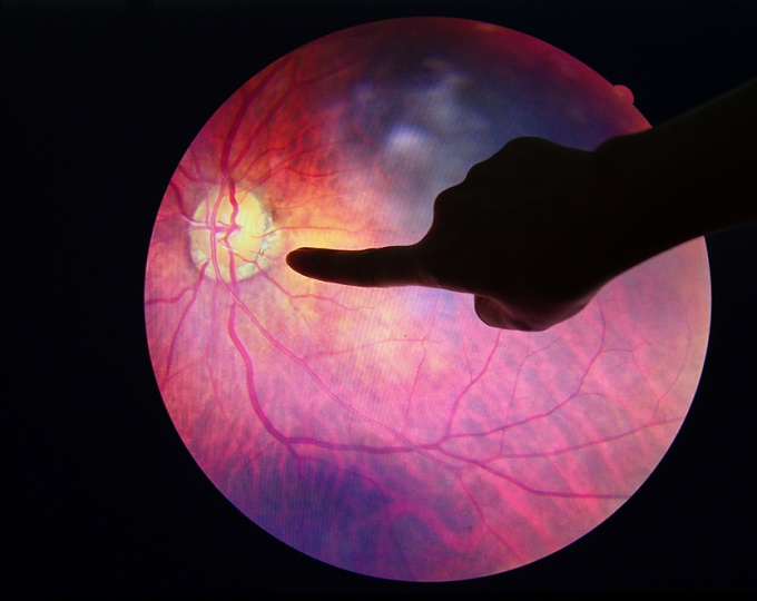 Оптимальный интервал скрининга диабетической ретинопатии, какой он?  