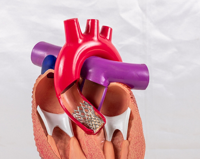 Сахарный диабет и риск осложнений после замены аортального клапана