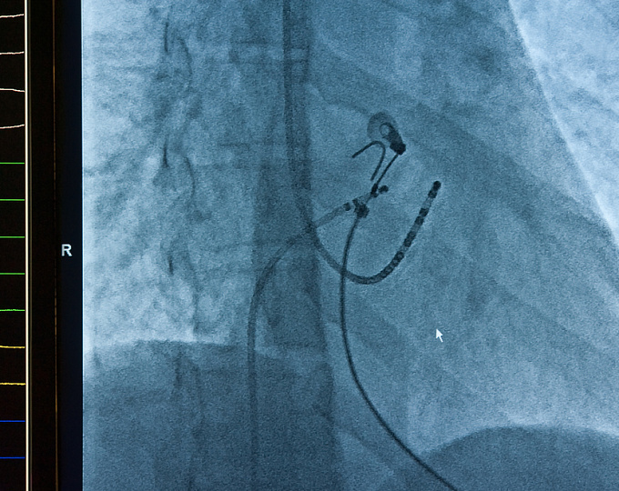 Аблация или антиаритмическая терапия для контроля ритма при ФП
