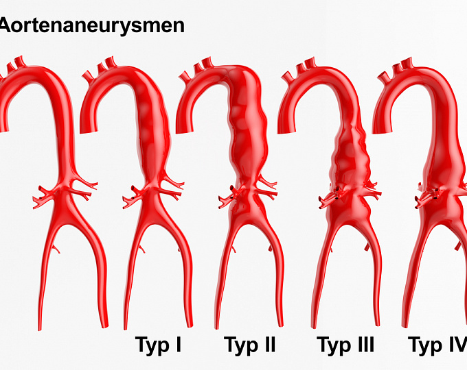 Обновление к рекомендациям USPSTF по скринингу аневризмы брюшной аорты