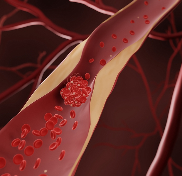 Оптимальный целевой ХС-ЛПНП у пациентов с атеросклеротическими сердечно-сосудистыми заболеваниями