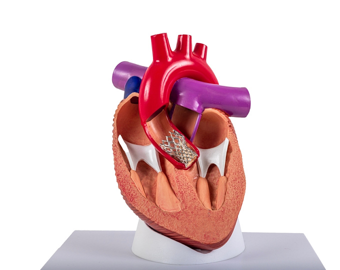 Хирургическая или транскатетерная замена аортального клапана у пациентов низкого риска: результаты 7-летнего наблюдения