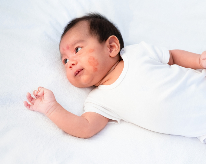 Материнский индекс массы тела как фактор риска атопического дерматита у детей