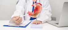 До 22% случаев перфоративной язвенной болезни не связаны с H. pylori или приемом НПВП