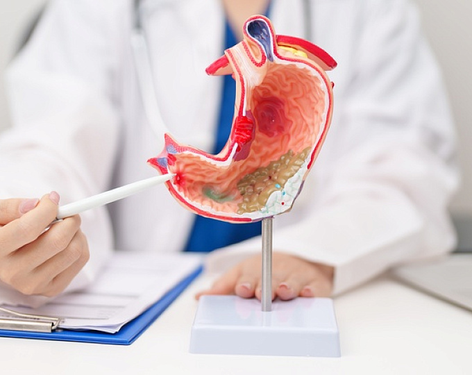 До 22% случаев перфоративной язвенной болезни не связаны с H. pylori или приемом НПВП