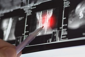 Риск развития неблагоприятных исходов беременности у женщин со спондилоартритом
