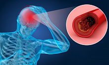 Предикторы внутримозгового кровотечения после тромбэктомии