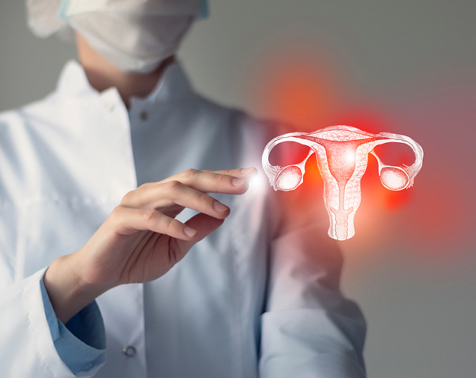 Риск преждевременной смерти на фоне эндометриоза и миомы матки