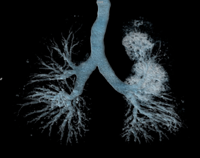 Существует ли польза от назначения ингаляционных кортикостероидов у пациентов с бронхоэктазами?